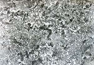 F,27y. | endomyocardial fibrosis F,27y. | endomyocardial fibrosis